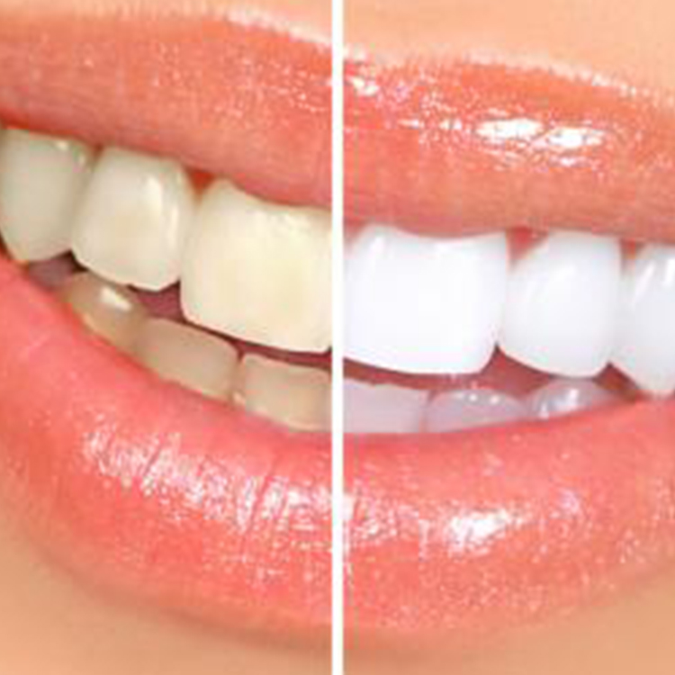 Aesthetic Dental Studio - Vandhana Ahuja DDS- Before and After Gallery