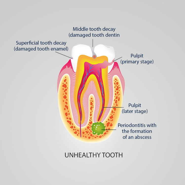 Aesthetic Dental Studio - Vandhana Ahuja, DDS- Root Canal Therapy- Hamilton, NJ